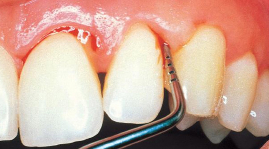 Periodontitis enfermedad periodontal Clínica Dental NoemiDent